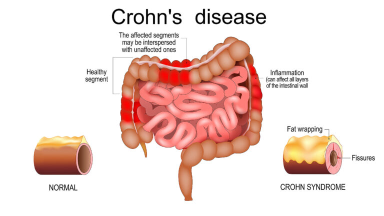 🩺 Τι είναι η νόσος Crohn και πώς επηρεάζει το πεπτικό σύστημα;