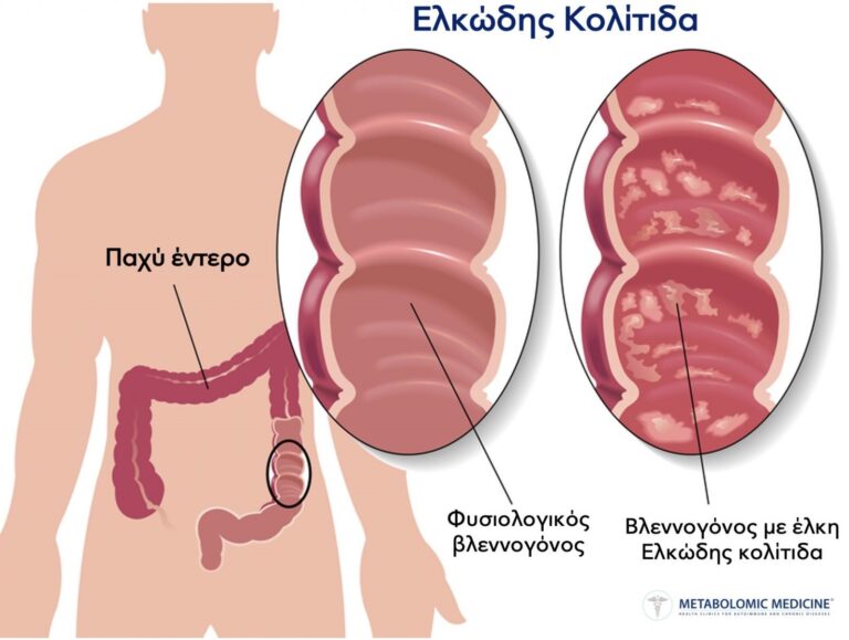 🩺 Τι είναι η ελκώδης κολίτιδα και πώς επηρεάζει το παχύ έντερο;